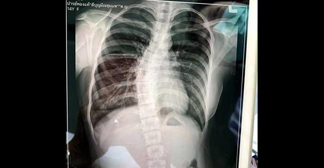 หมอกระดูกชี้ ‘น้องโทนี่’ สันหลังคด ไม่เกี่ยวกับกระเป๋าหนัก | News by The Thaiger