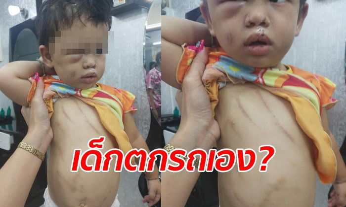แม่ช็อก! จ้างคนรู้จักเลี้ยงลูกสาว 1 ขวบ กลับมาเจอตาปูด แผล-ช้ำทั้งตัว | The Thaiger
