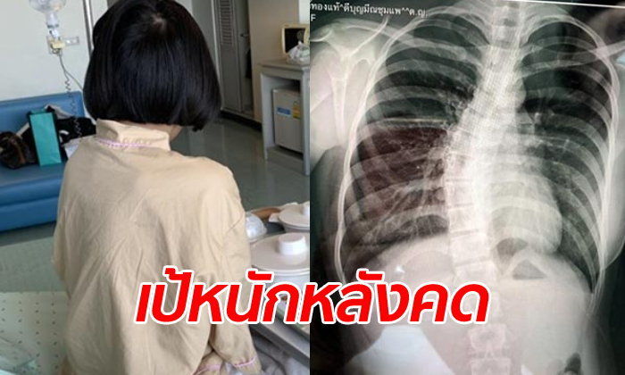 พบเด็ก 14 กระดูกสันหลังคด แม่เชื่อเพราะกระเป๋านักเรียนหนัก | The Thaiger