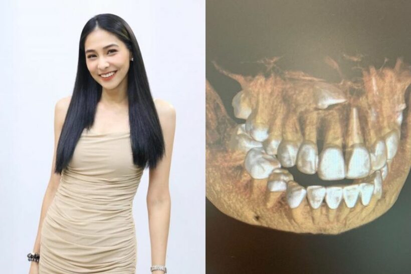 ผ่าออกด่วน! “บูม สุภาพร” ผ่าตัดฟันคุดโผล่กลางหน้าใกล้เส้นประสาท | The Thaiger