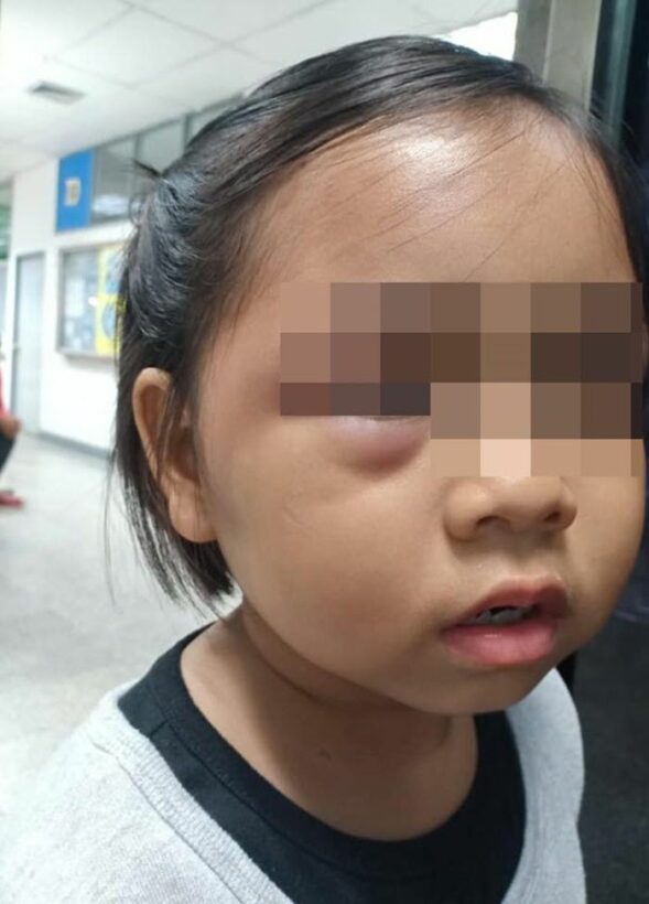 เด็กน้อยโดนครูฟาดหน้าบวมช้ำ อ้างทำเพราะบวกเลขช้า | News by The Thaiger