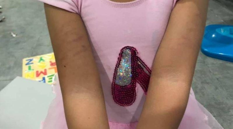 Child’s bruises spark suit against school