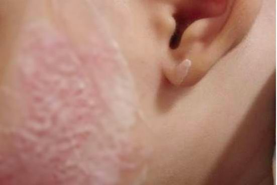 เด็กน้อยผื่นเห่อแก้ม หลังถูกพระเคี้ยวหมากเป่ากระหม่อม | The Thaiger