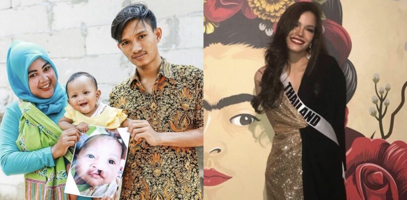 ฟ้าใส ชวนบริจาคเงินช่วยเหลือผู้ป่วยโรคปากแหว่งเพดานโหว่ | The Thaiger
