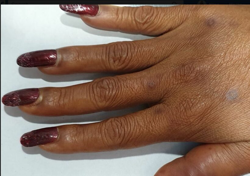 Doctor in southern Thailand issues warning after manicure goes VERY wrong