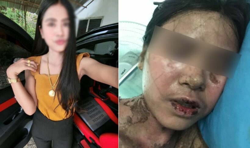 สาวเล่า ปวดฟันคุด ซื้อยาไอบูโพรเฟนกินเอง สุดท้ายเข้า ICU 7 คืน | The Thaiger