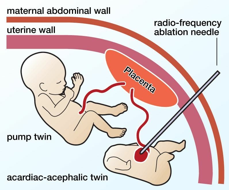 Doctors successfully perform Thailand's first 