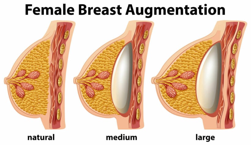 Breast augmentation in Thailand