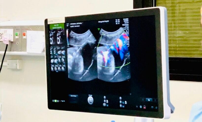 Doctors successfully perform Thailand's first "acardiac twin" surgery | News by Thaiger