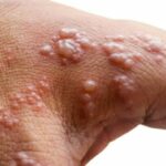 Monkeypox is not a shingles mingle or side effect of Covid-19 vax | Thaiger