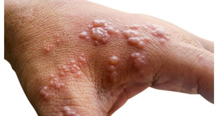 Monkeypox is not a shingles mingle or side effect of Covid-19 vax