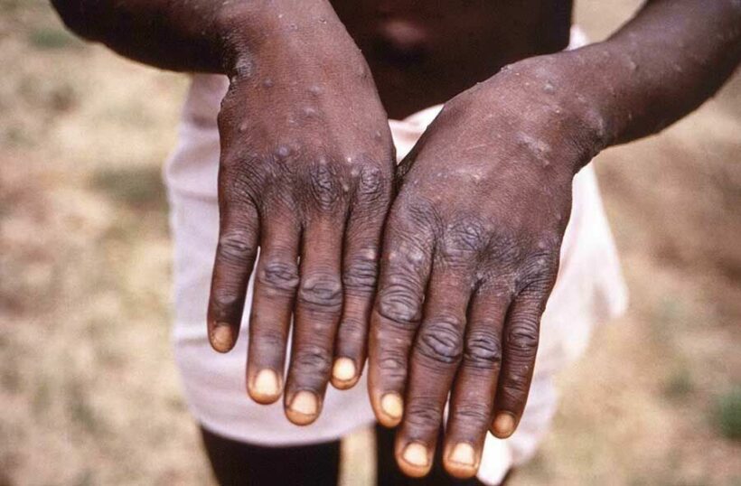 Monkeypox is not a shingles mingle or side effect of Covid-19 vax 