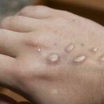 Three mpox cases found in Thailand | Thaiger