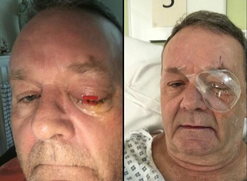 British man loses his eye to an infection from Pattaya