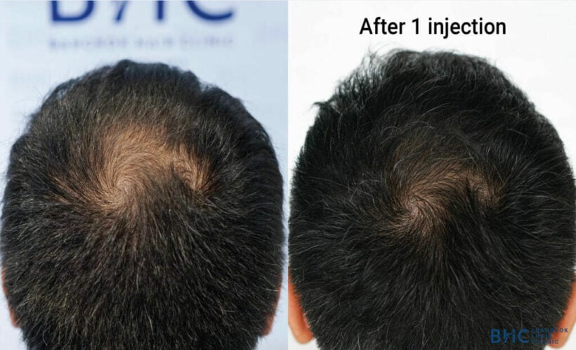 Experience amazing hair restoration procedures at Bangkok Hair Clinic | Thaiger Experience amazing hair restoration procedures at Bangkok Hair Clinic | Thaiger