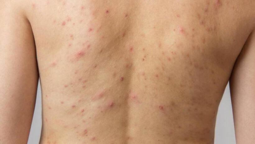 Skin disorders commonly found in Thailand | News by Thaiger