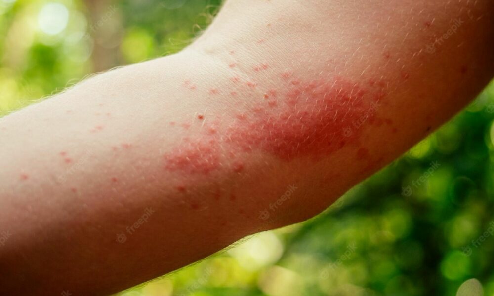 Skin disorders commonly found in Thailand Thaiger