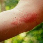 Skin disorders commonly found in Thailand | Thaiger