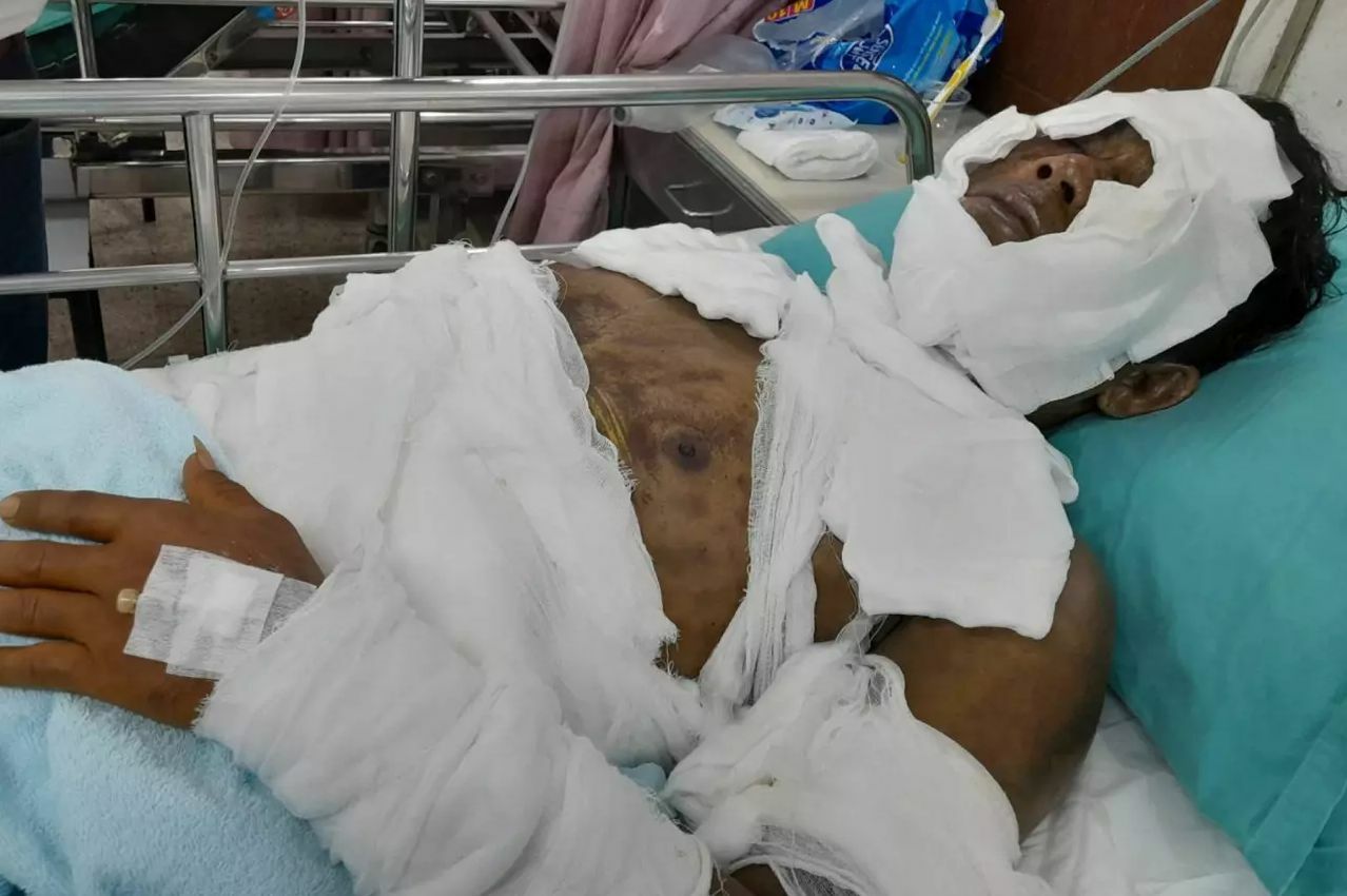 Thai man saves girlfriend from ex’s acid attack, suffers severe injury