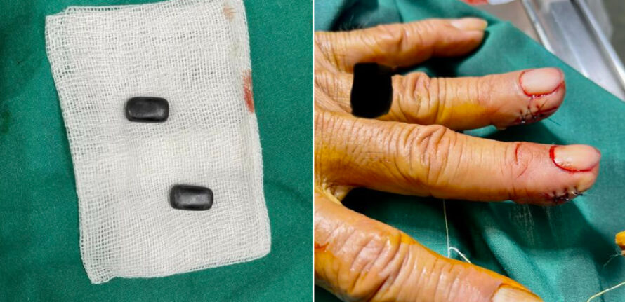 Thai man implants magnets into his fingers for 40 years to win at Hi-Lo