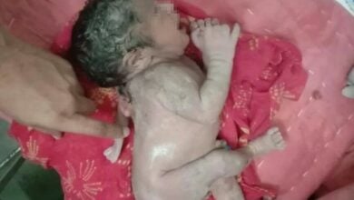 Indian baby with rare case of third arm growing from her back cries when touched