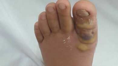 Unusual case: Foot hair removal turns septic, lands Vietnamese woman in hospital