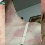 Food allergy: Thai woman&#8217;s severe reaction to buffet lunch prompts food safety warning | Thaiger