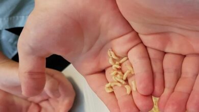 Turkish boy discovers 11 maggots after troubling eye irritation