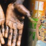 Thailand&#8217;s first Monkeypox-related death highlights rising infectious disease threat | Thaiger