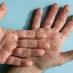 Monkeypox outbreak: Surge in cases among Thai teenagers | Thaiger