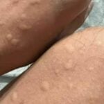 Lobster burger allergy sparks caution among seafood enthusiasts | Thaiger