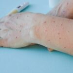 Mpox outbreak in Thailand: 24 infected, one death reported | Thaiger