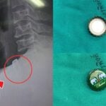 Man swallows beer bottle cap during New Year&#8217;s Day celebration in Thailand | Thaiger