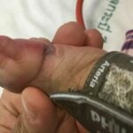 Six month old Thai baby&#8217;s foot swollen due to tight pulse band | Thaiger