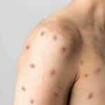 Disease Control warns of mpox surge after Songkran festival | Thaiger