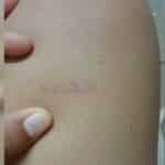 TikTok user&#8217;s burn mark sparks lottery speculation (video) | Thaiger