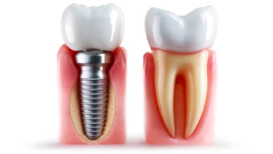 Dental implants and dental crowns: Differences between them