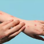 New deadly Mpox strain raises concerns about possible global spread | Thaiger