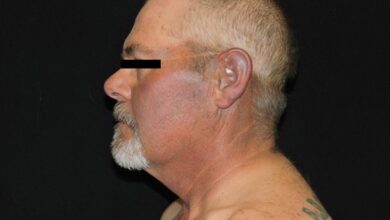 Beware as kratom usage is linked to skin hyperpigmentation