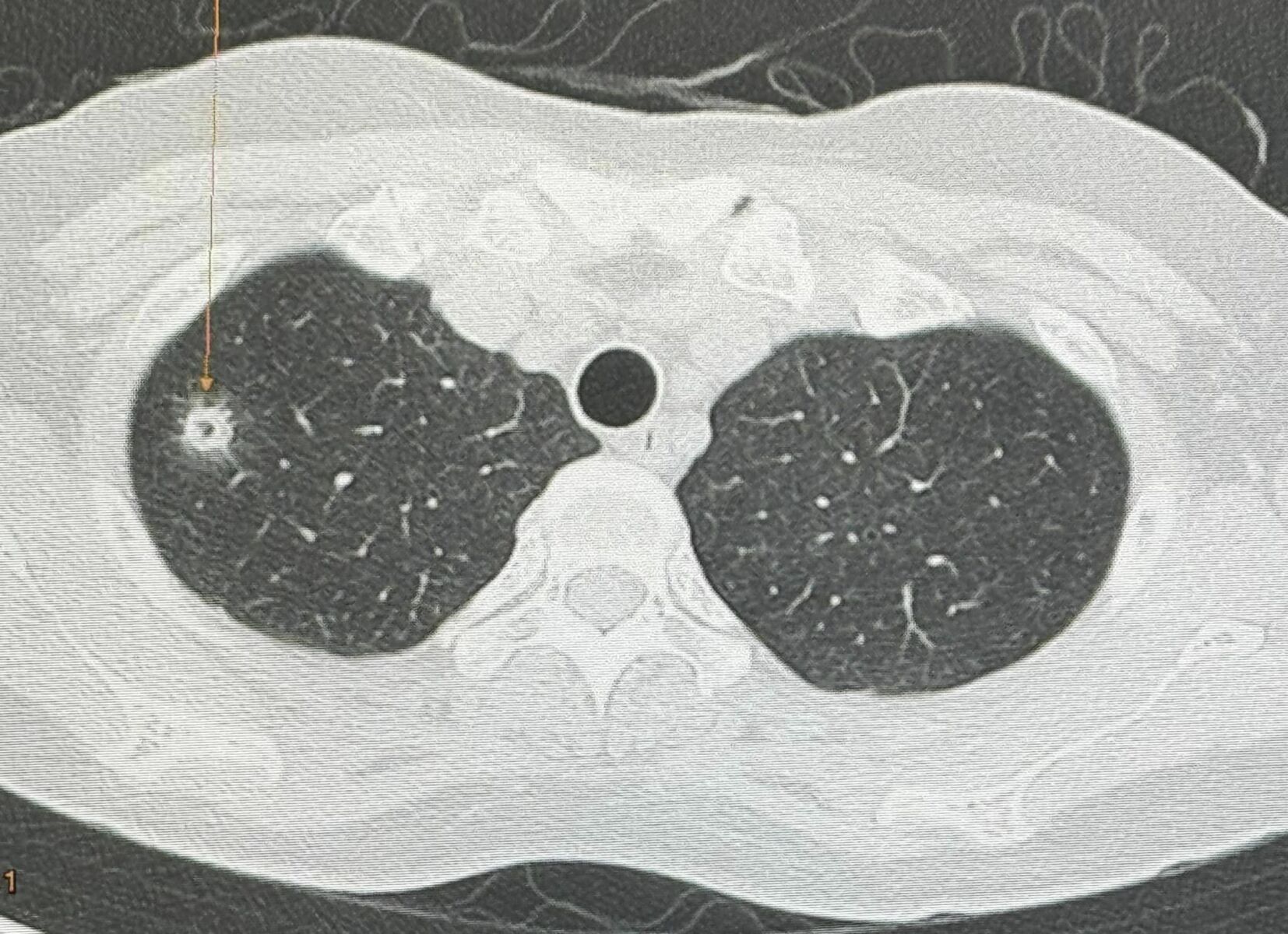 Bangkok woman contracts rare lung infection from feeding pigeons | News by Thaiger