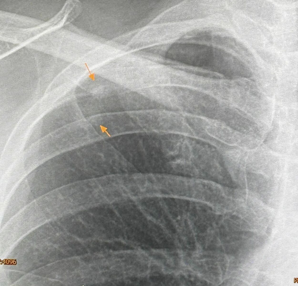 Bangkok woman contracts rare lung infection from feeding pigeons | News by Thaiger