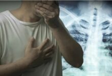TB outbreak looming on Thailand-Myanmar border