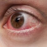 Thailand’s DDC issues health alert on rising eye infections due to contaminated tap water | Thaiger