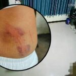 Woman alleges assault by district officer boyfriend, fractured ribs | Thaiger
