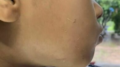 Worms emerge from boy’s face after medium’s treatment (video)