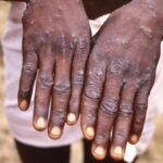 Thailand on alert as WHO considers mpox emergency declaration | Thaiger