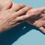 Thai Red Cross offers mpox vaccine for 8,500 baht per dose | Thaiger