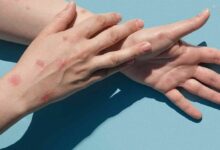 Thai Red Cross offers mpox vaccine for 8,500 baht per dose | Thaiger