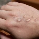 FDA puts the &#8216;test&#8217; in &#8216;protest&#8217; over mpox spread | Thaiger