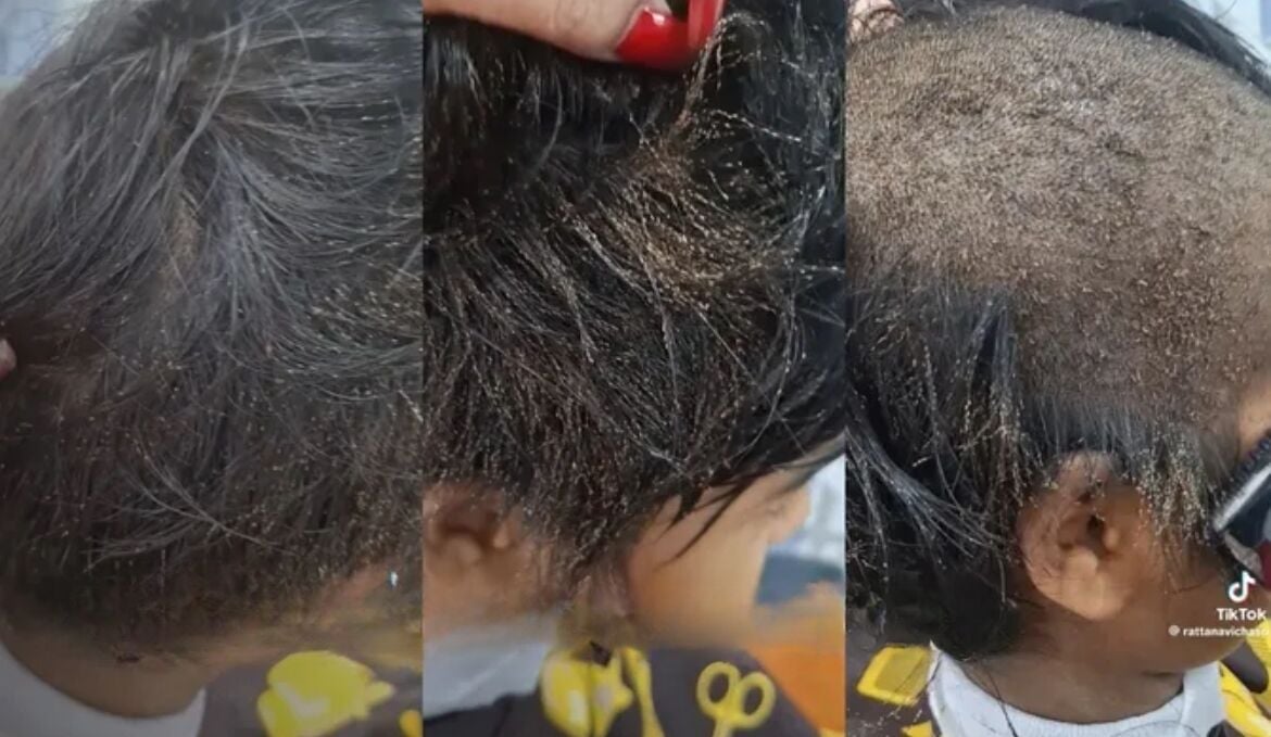 Lice to meet you: TikTok clip of girl’s hair-raising ordeal bugs social media